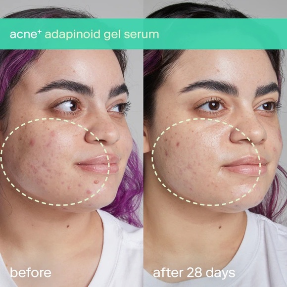 NEW✅ Skinfix Acne+ Adapinoid Gel with Niacinamide + Squalane - Picture 2 of 7